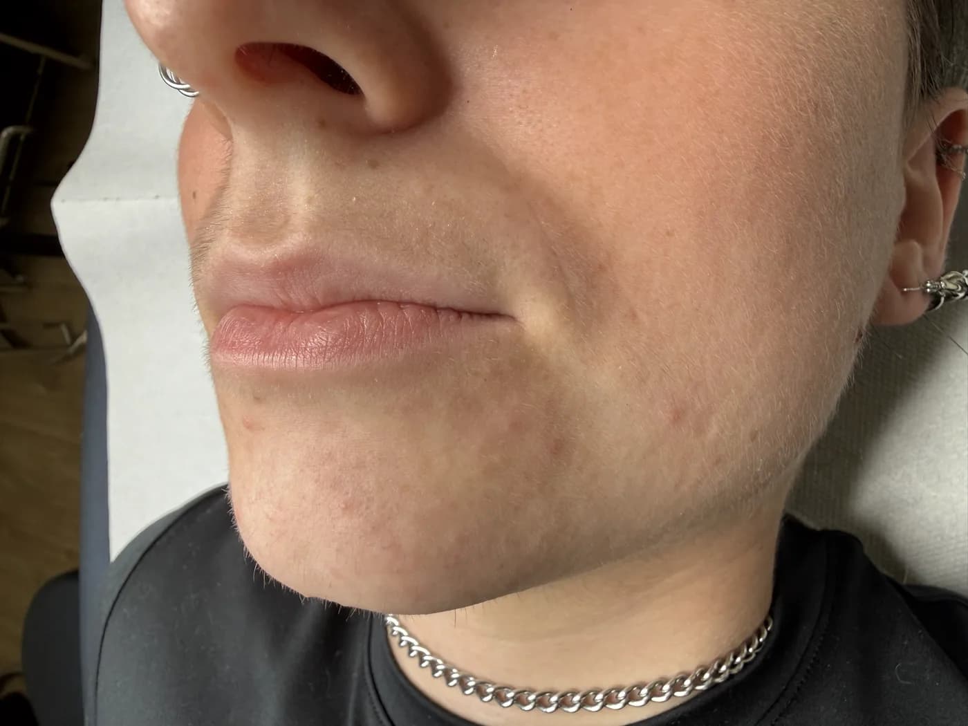 Résultat d’une dermopigmentation des lèvres, exemple 1
